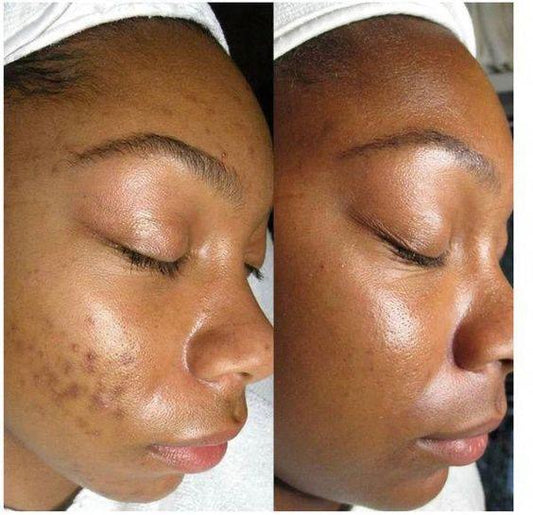 Soin anti - taches et anti - imperfections
