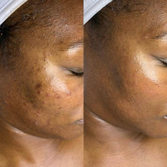 Savon Kojie San – Le secret pour une peau nette et lumineuse