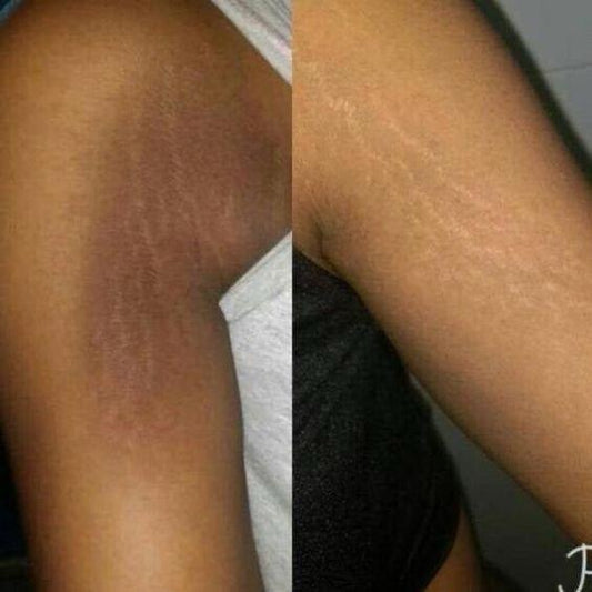 Crème de massage anti - vergétures